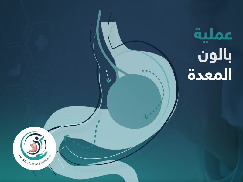 بالون المعدة