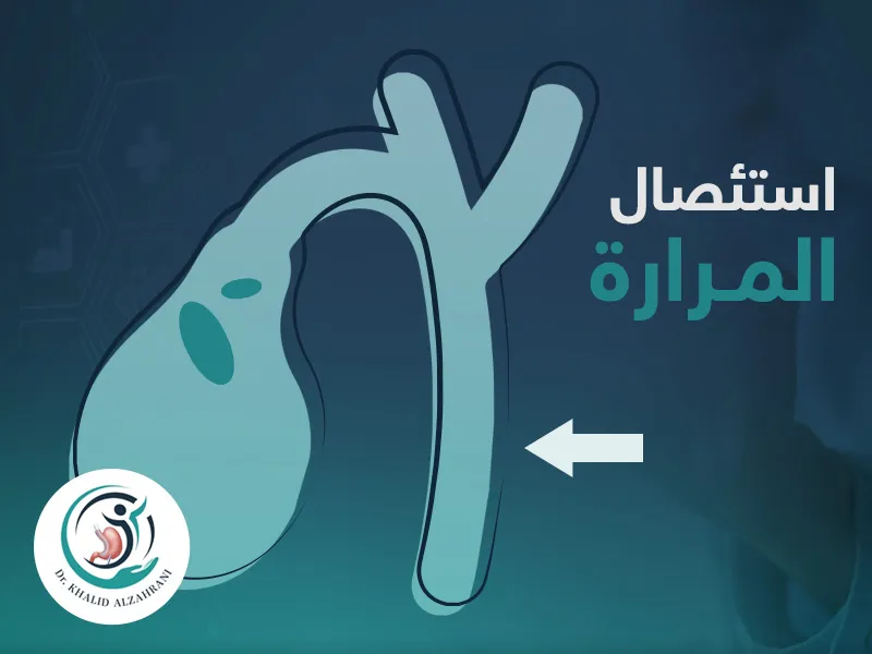 جراحة استئصال المرارة