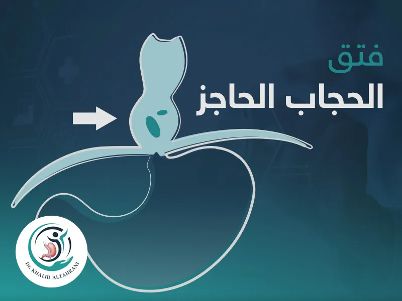 فتق الحجاب الحاجز