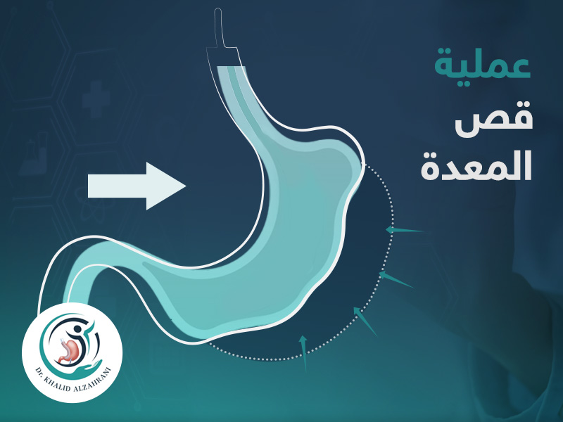 عملية قص المعدة