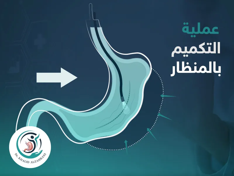 عملية التكميم بالمنظار