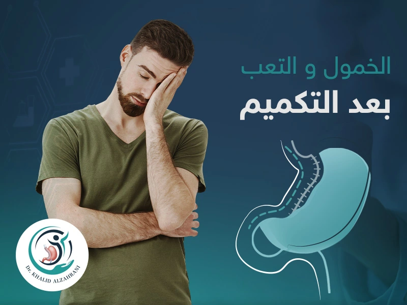 الخمول والتعب بعد التكميم