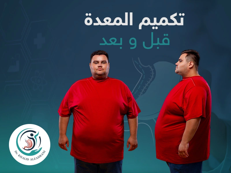 تكميم المعدة قبل وبعد