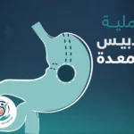 عملية تدبيس المعدة