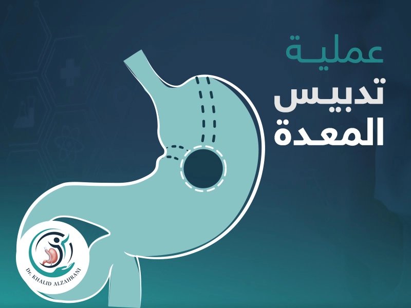 عملية تدبيس المعدة